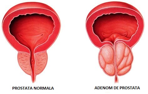 adenom de prostata operatie endoscopica