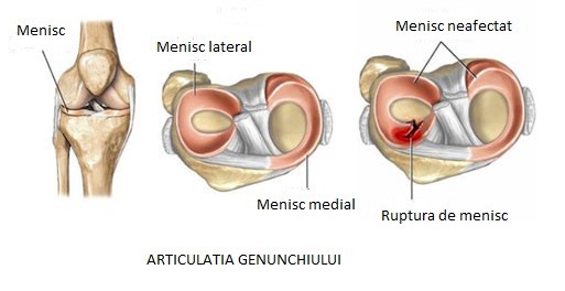 inflamația meniscului intern al genunchiului