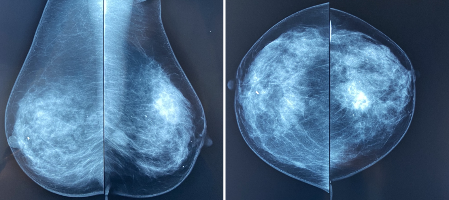 доброкачественные опухоли в груди у женщин фото 83