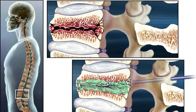 tratament minim invaziv al coloanei vertebrale