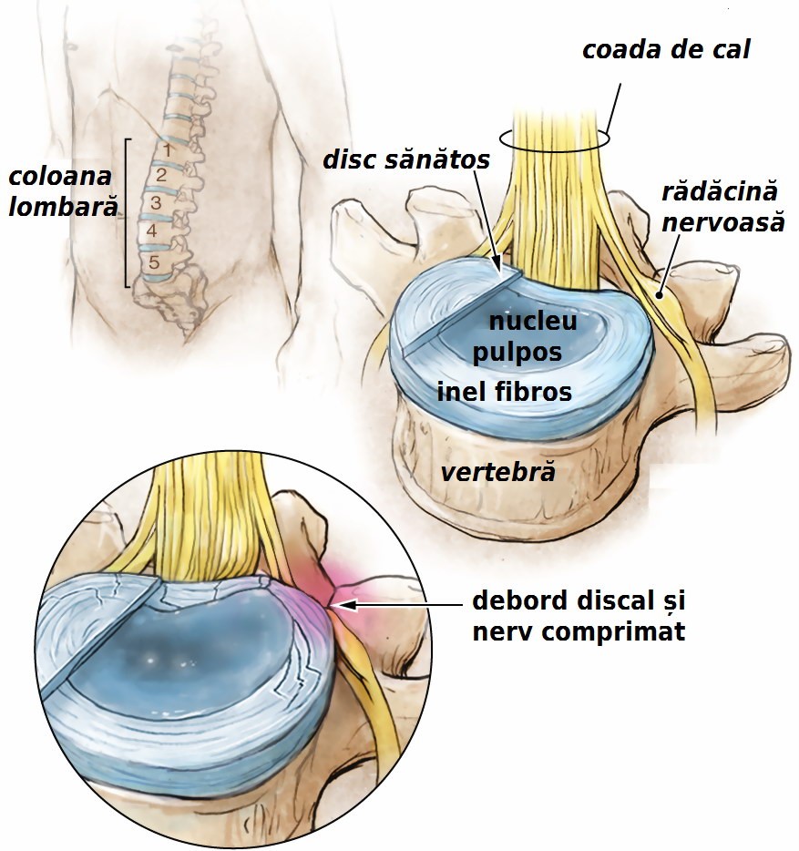 Osteoartrita coloanei vertebrale: simptome și tratament